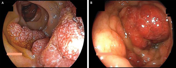 Gastrointestinal Kaposi’s Sarcoma