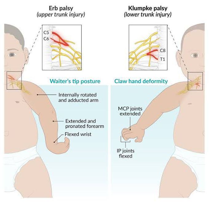 Erb Palsy and Klumpke Palsy