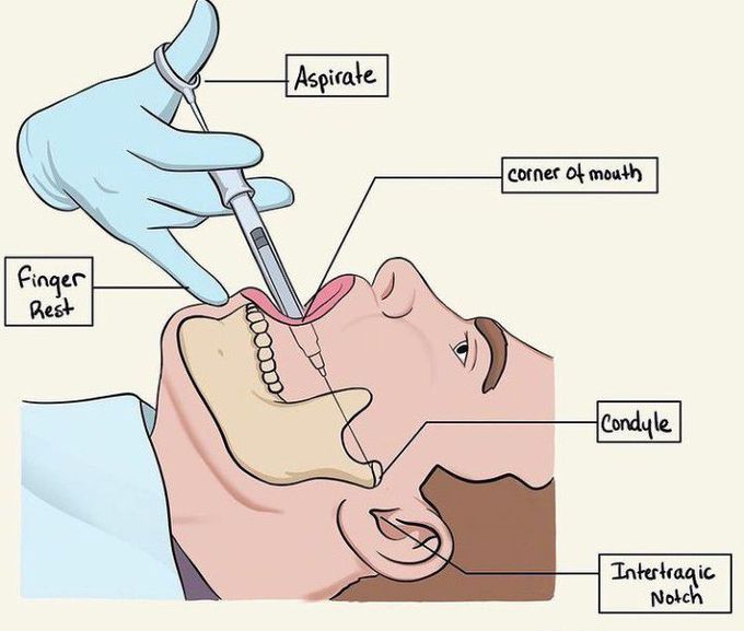 Gow-Gates technique for mandibular nerve block