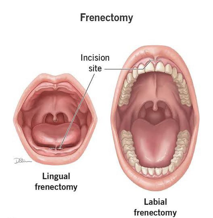 Lingual frenectomy