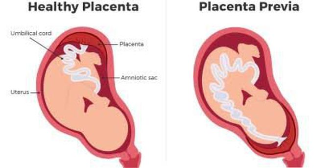 Placenta previa