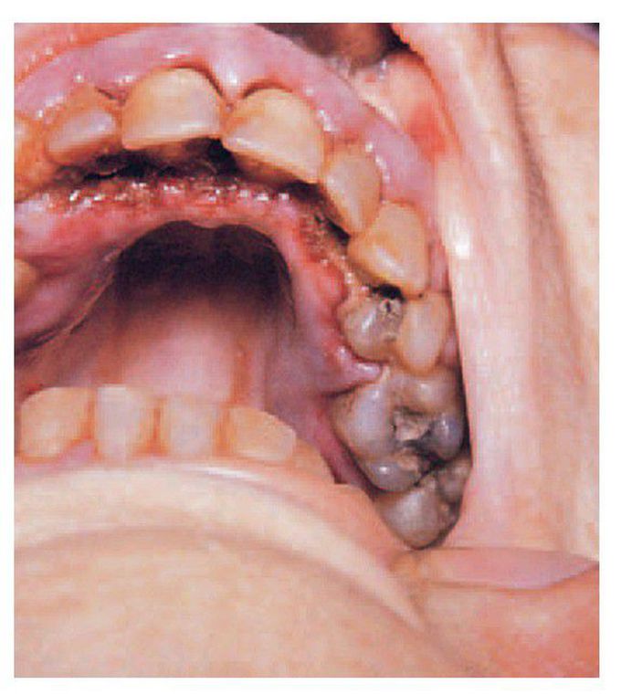 Acute myelocytic leukaemia.