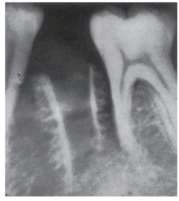 Sequestration in a severe dry socket.