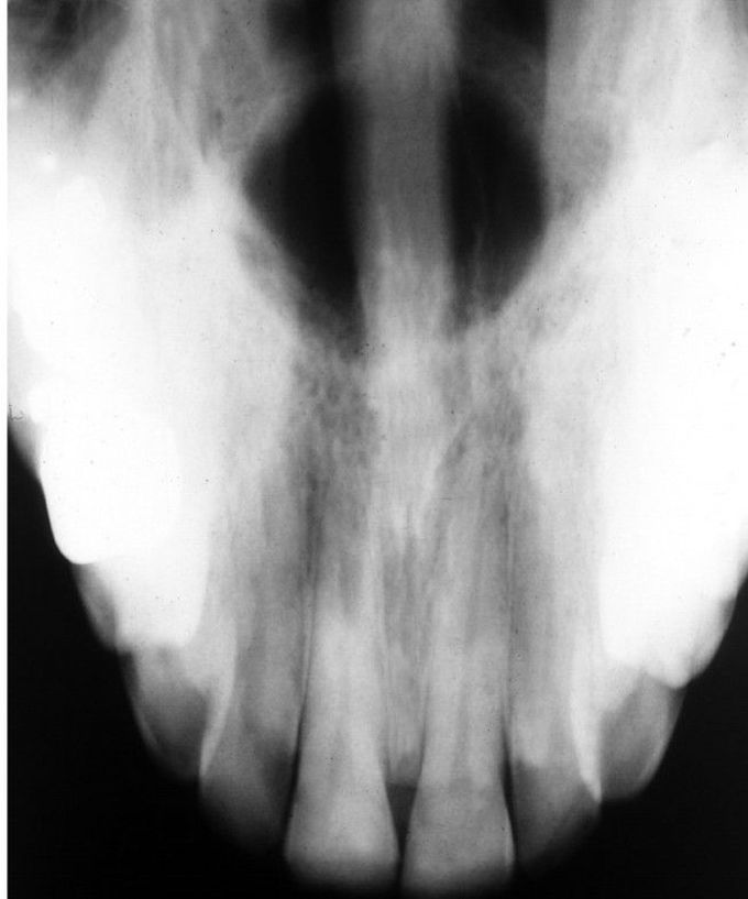 Median palatal cyst