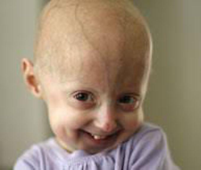 Hutchinson Gilford Progeria Syndrome Medizzy