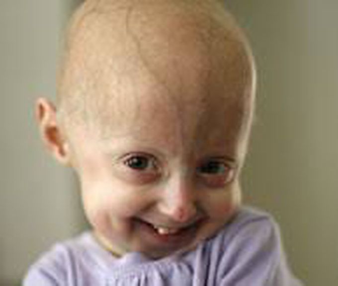 HUTCHINSON-GILFORD PROGERIA SYNDROME