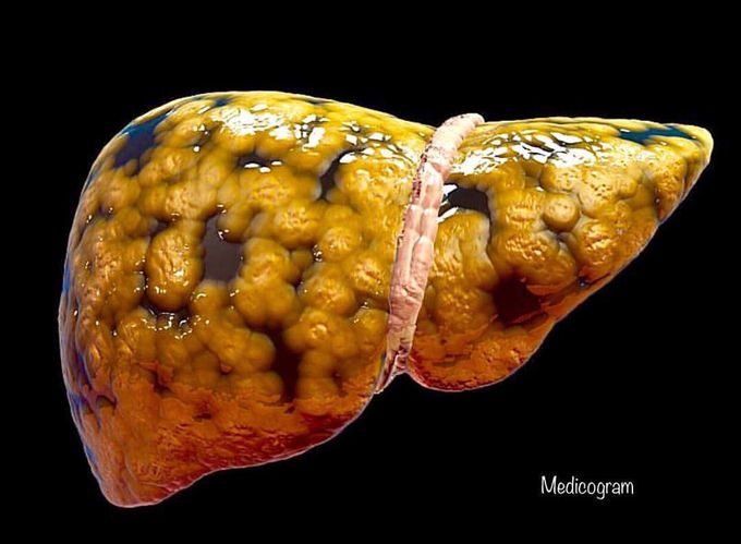 Hepatic Steatosis (Fatty Liver Disease)