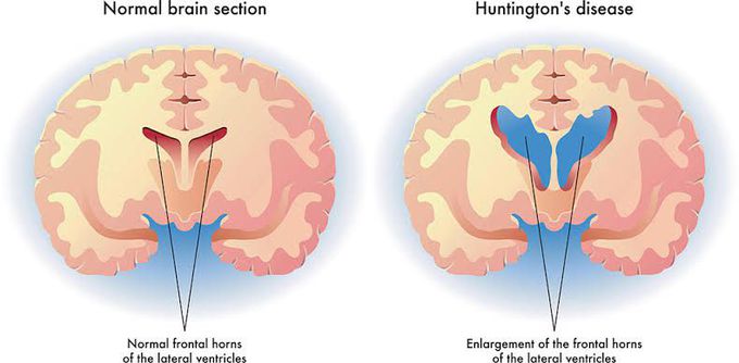 What is Huntingtons disease?