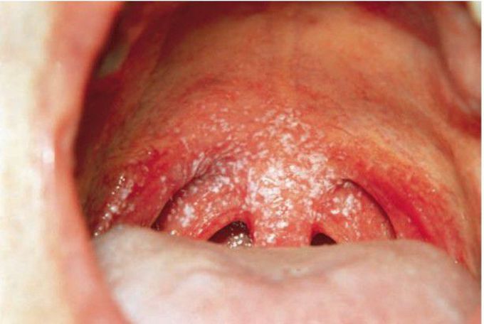 Candidiasis