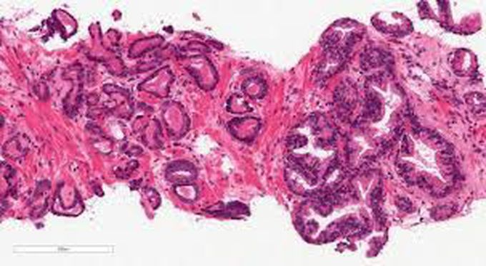 Causes of prostatic adenocarcinoma