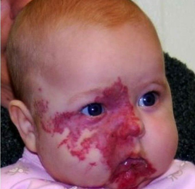 Classical finding in picture supports diagnosis of?