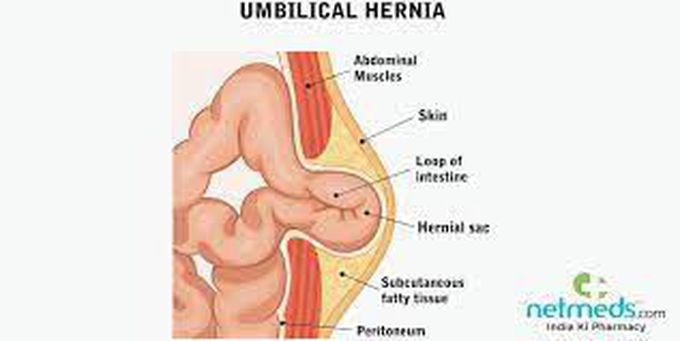 Umbilical hernia