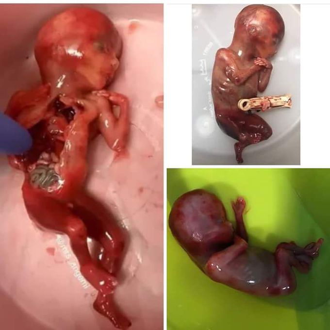Case of spontaneous abortion for 16 weeks fetus 😣
