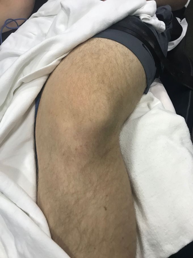 Patellar Dislocacation