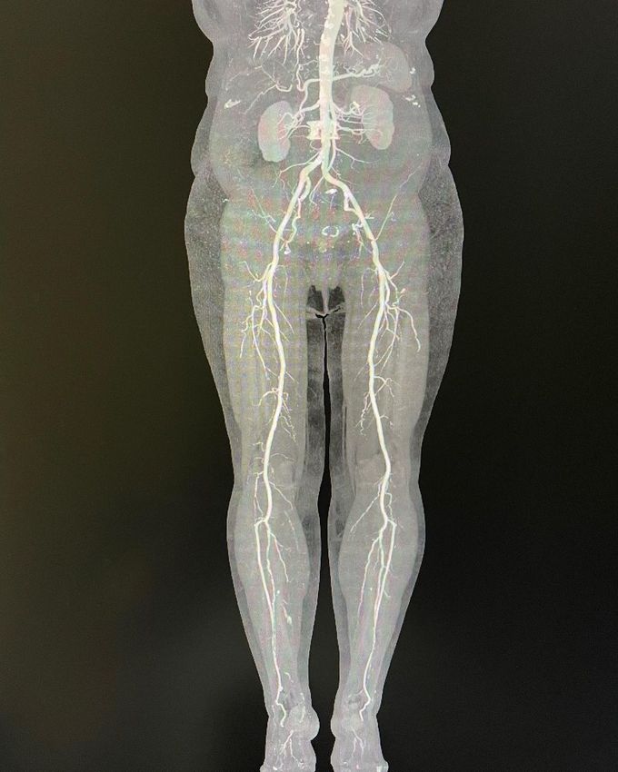 Angiogram of Abdominal Aorta