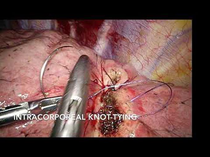 Indications in Thoracoscopic Suturing