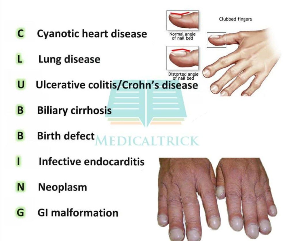 Causes of Clubbing | Mnemonic - MEDizzy