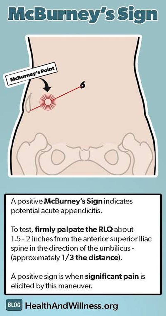 McBurney's Sign