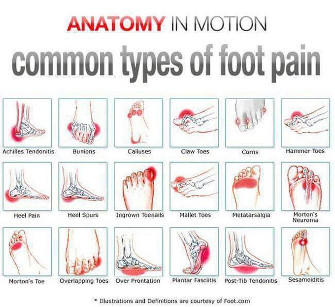 TYPES OF FOOT PAINT IN AN INDIVIDUAL.