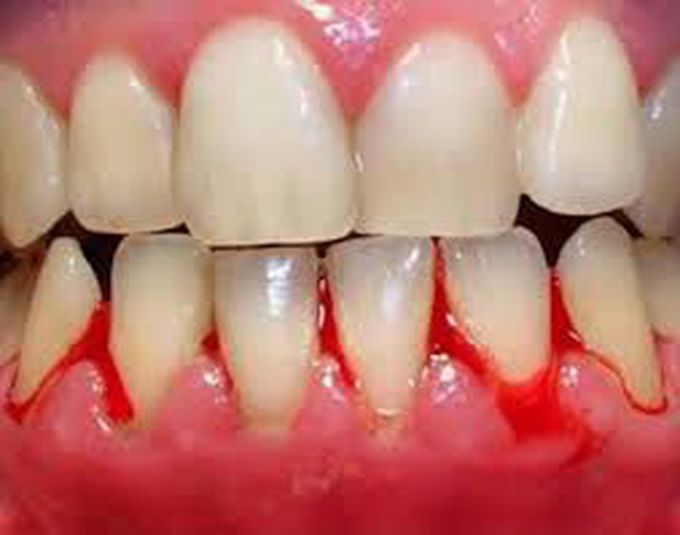 Treatment of bleeding gums