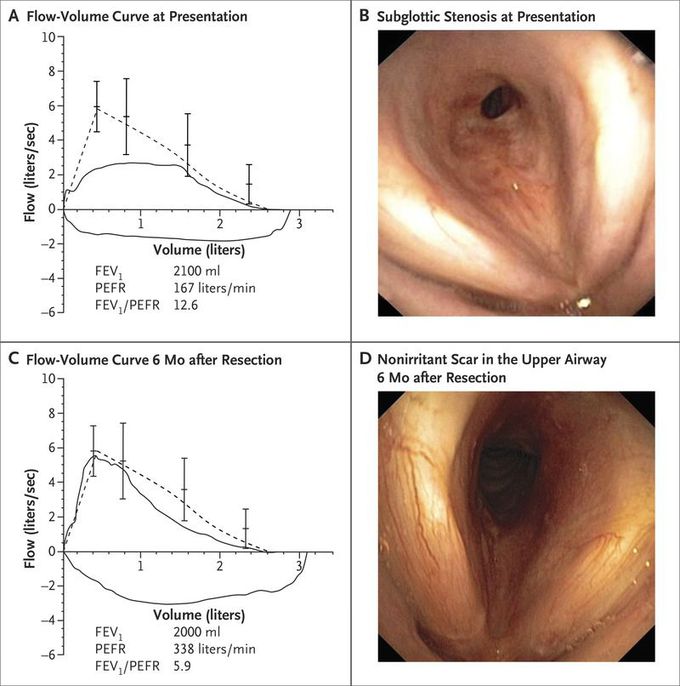 Subglottic Stenosis