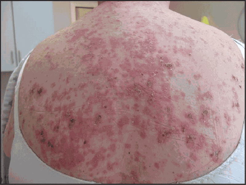 chronic cutaneous lupus