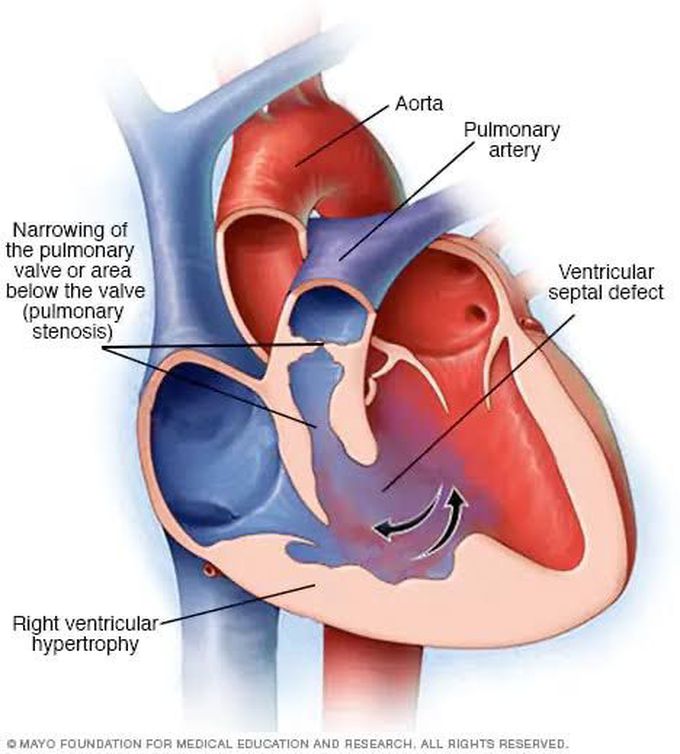 Tetralogy of Fallot