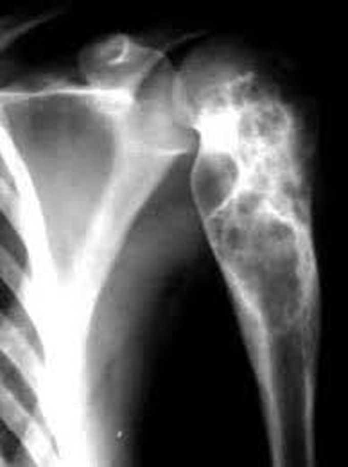 Aneurysmal bone cyst