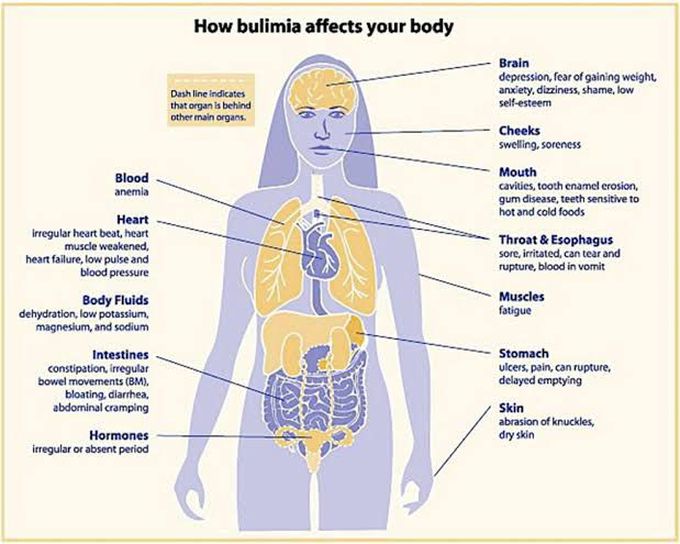 Bulimia Nervosa