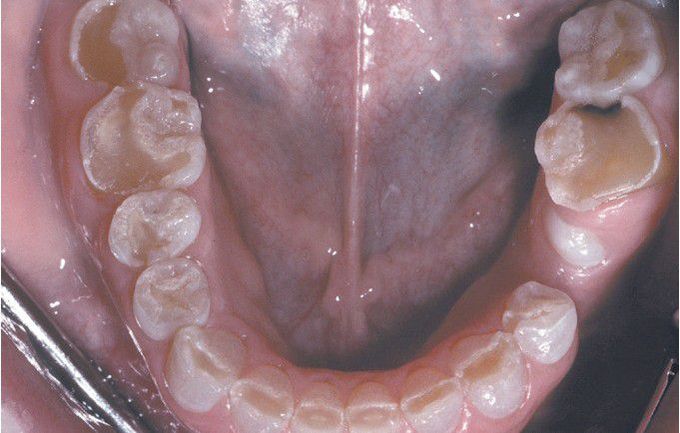 Dentinogenesis Imperfecta (DGI