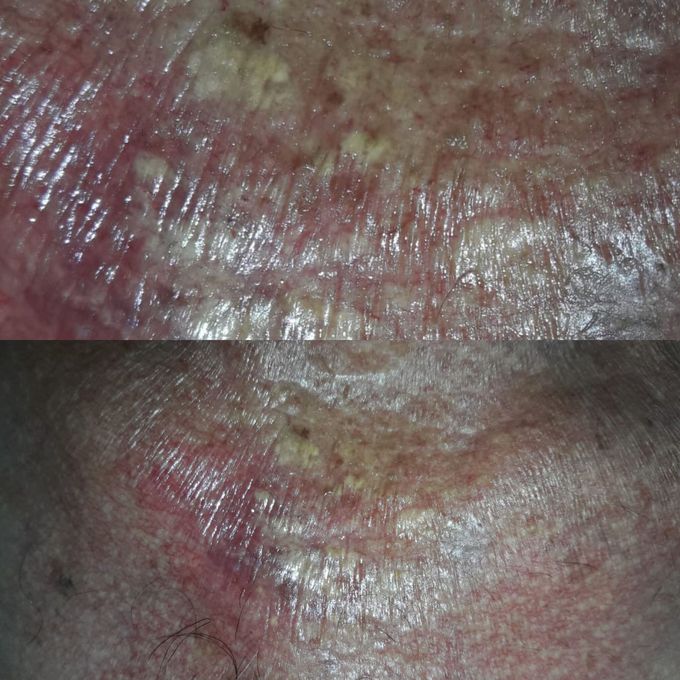 A 65 years old male appeared a swelling on his neck,what is your diagnosis??