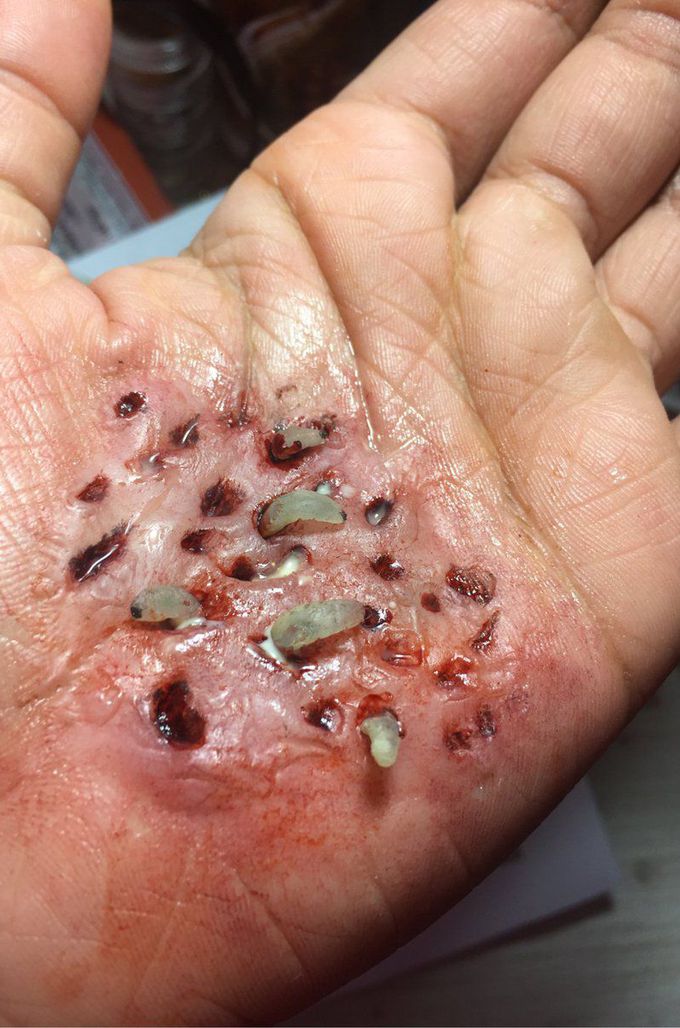 maggots eating flesh