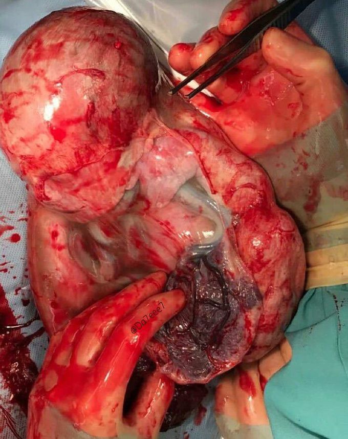 Infant born in a sac