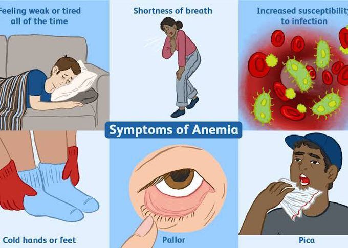 Signs and symptoms of anemia