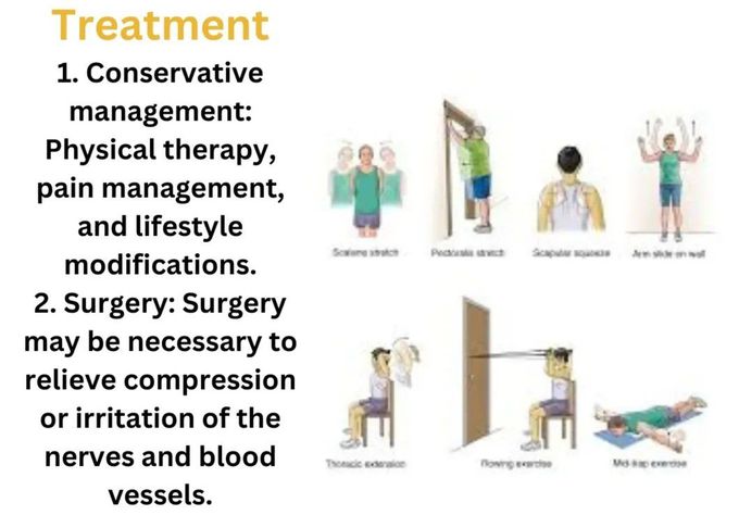 Thoracic Outlet Syndrome V