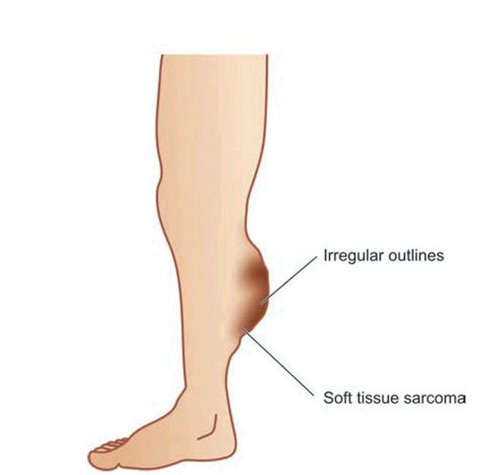 Fibrosarcoma