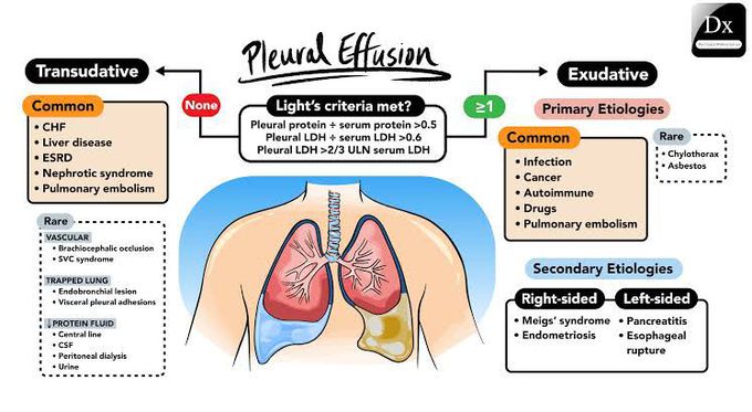 Pleural Effusion light's criteria