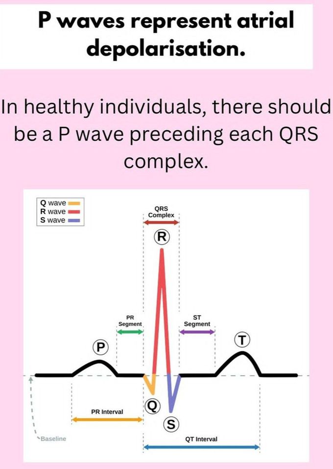 Atrial Depolarisation