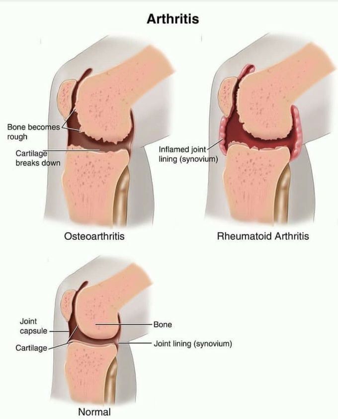 Arthritis