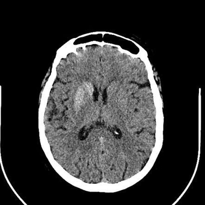 Hemiballismus