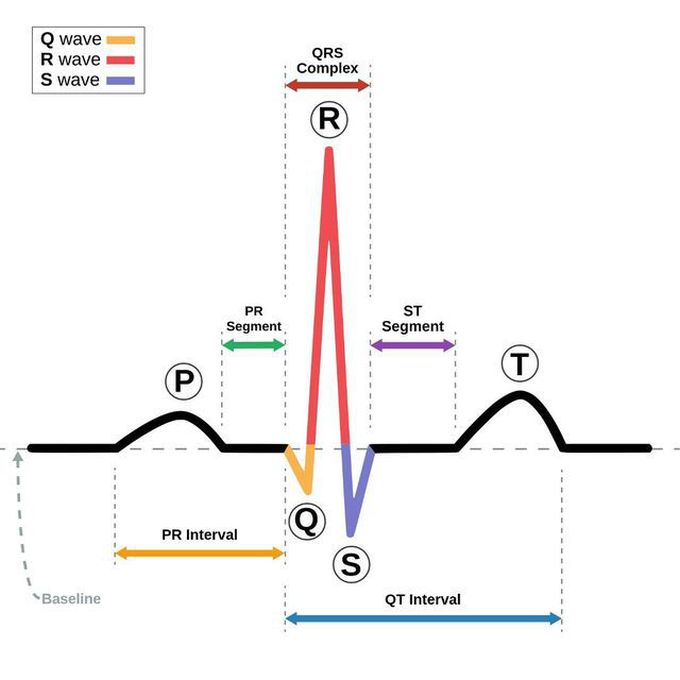 Normal sinus rhythm (NSR)