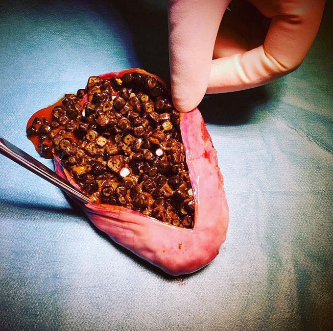 A gallbladder with marked cholelithiasis (gallstones), filled with hundreds of cholesterol stones!! 