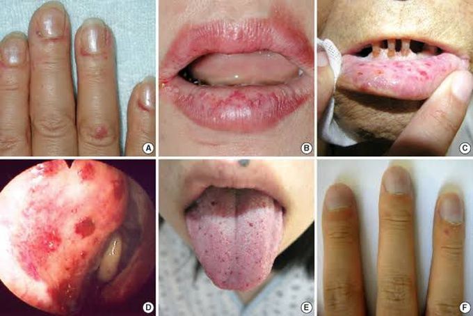 Hereditary hemorrhagic telangiectasia (HHT)