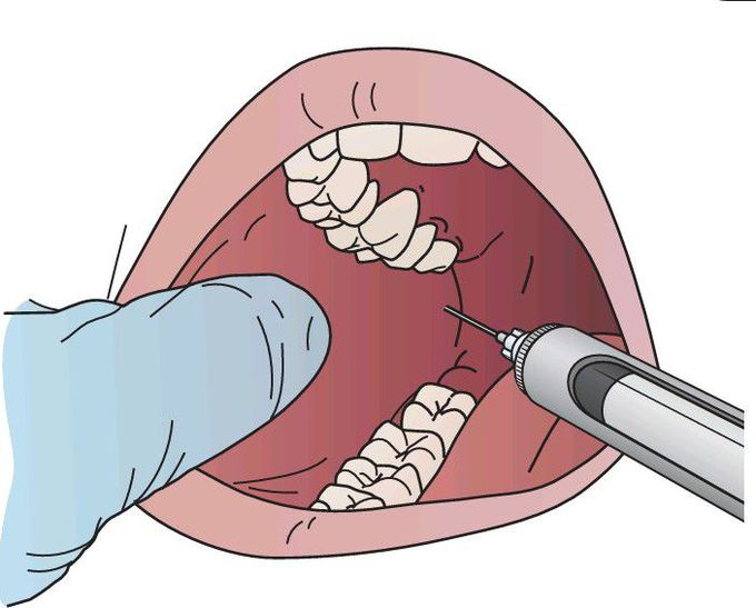 Inferior alveolar nerve block