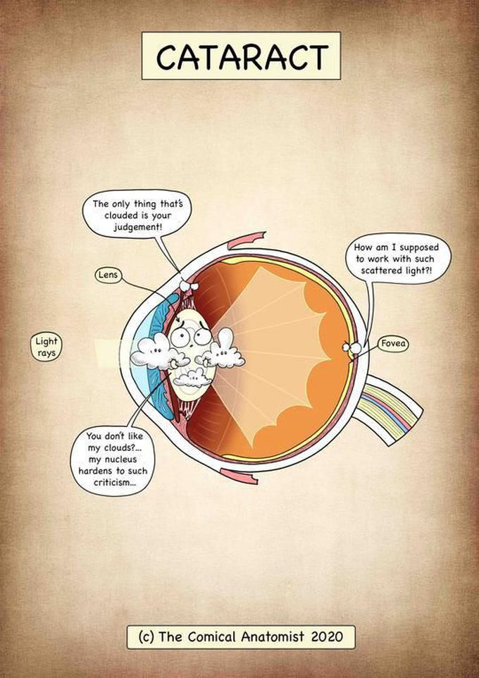 Cataract