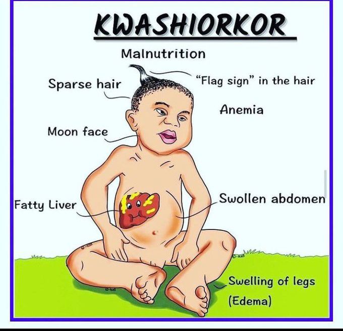 Kwashiorkor Kwashiorkor Definition