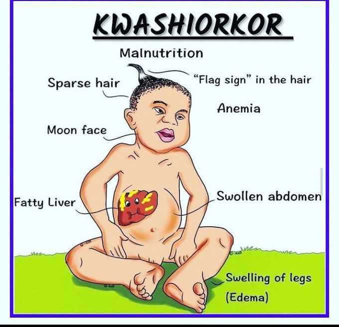 Kwashiorkor