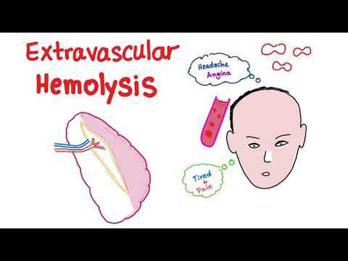 Pathology of Extravascular hemolysis