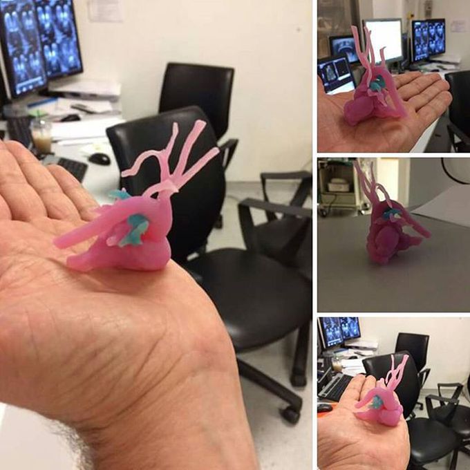 3D printing of repaired congenital disease of an infant