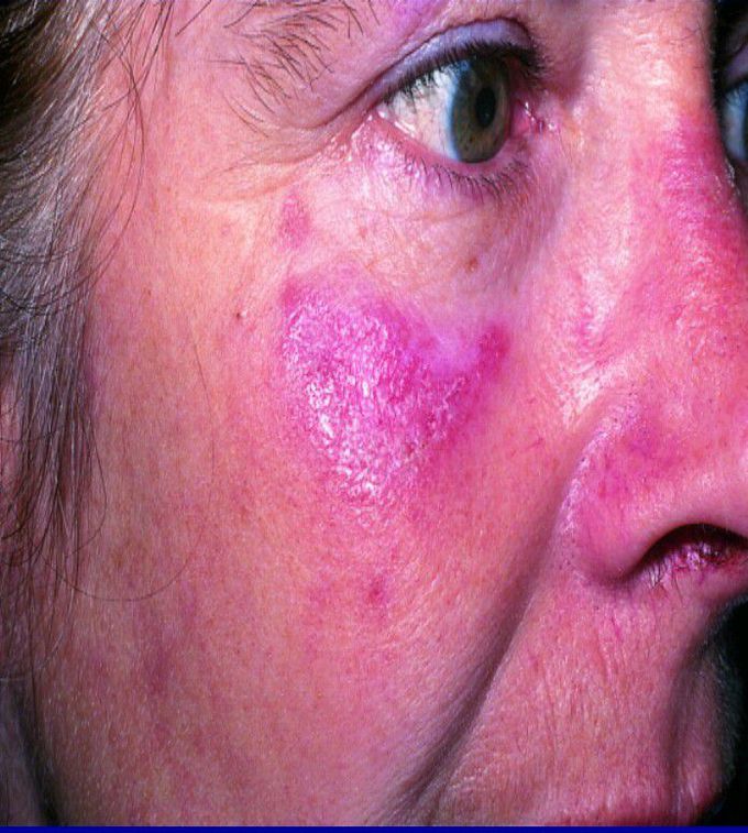 In which rheumatologic disease we see DLE sign??